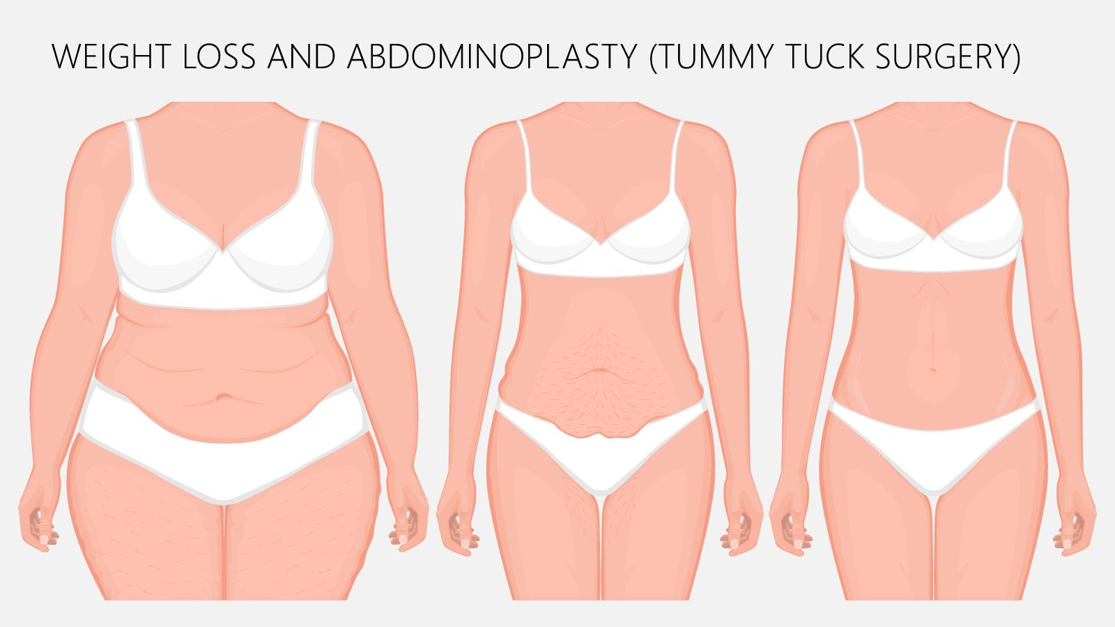 Tummy Tuck Surgery in Pune