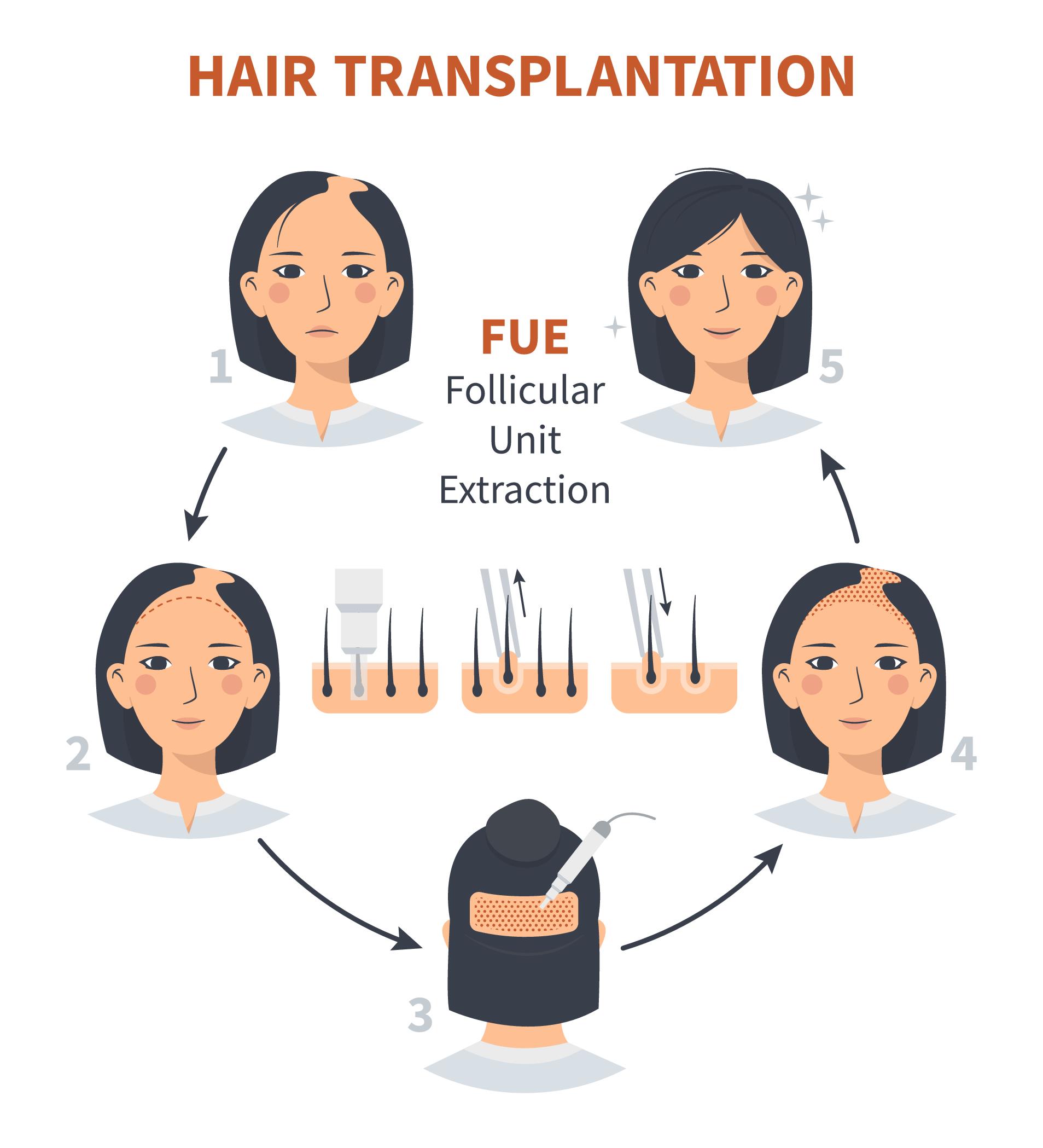 Best Hair Loss Treatment for Male & Female in Pune