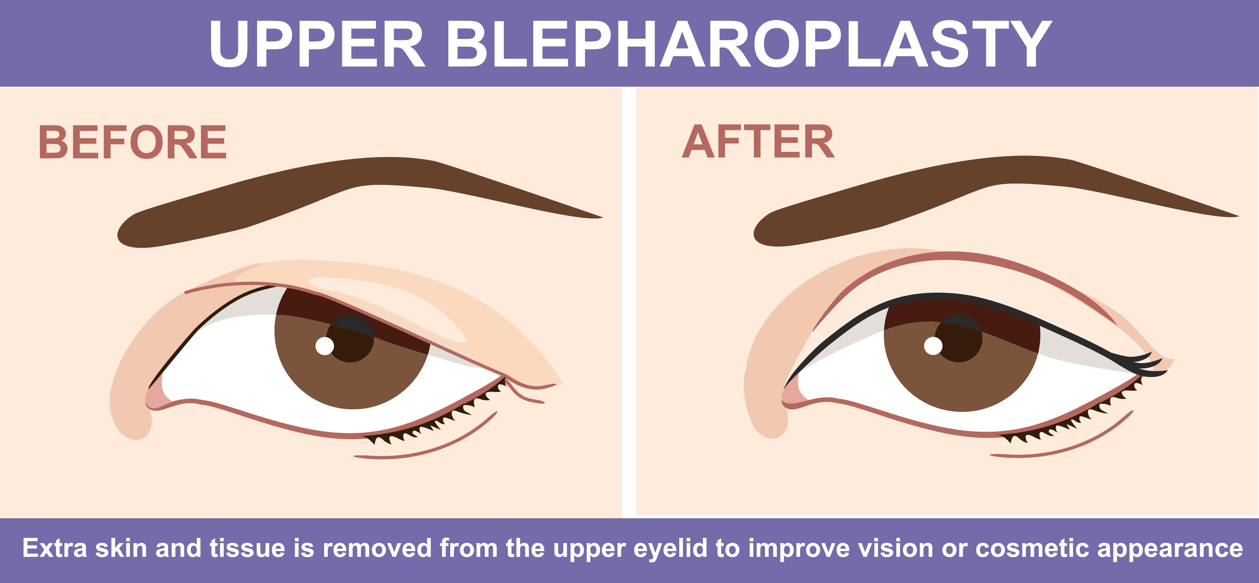 Blepharoplasty surgery in Pune