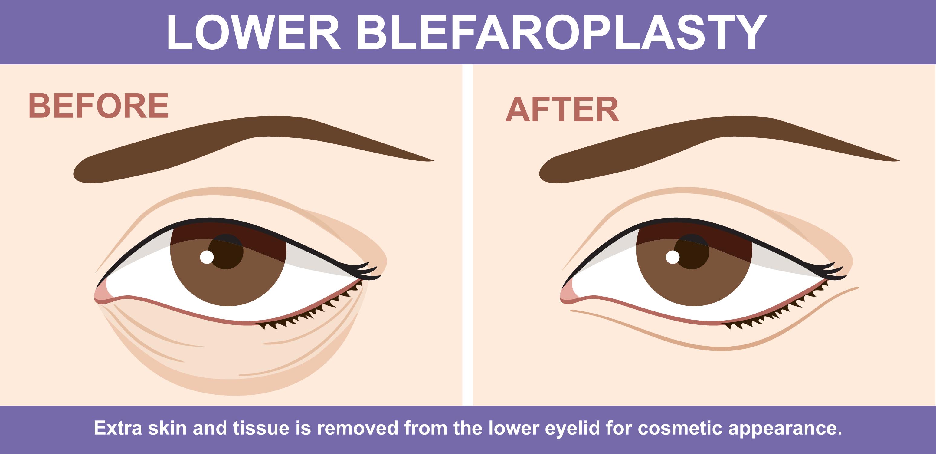 Blepharoplasty surgery in Pune