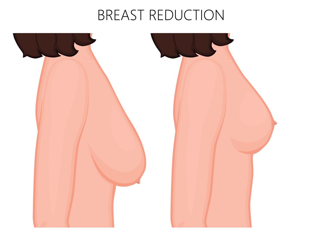 Breast Implants Surgery in Pune