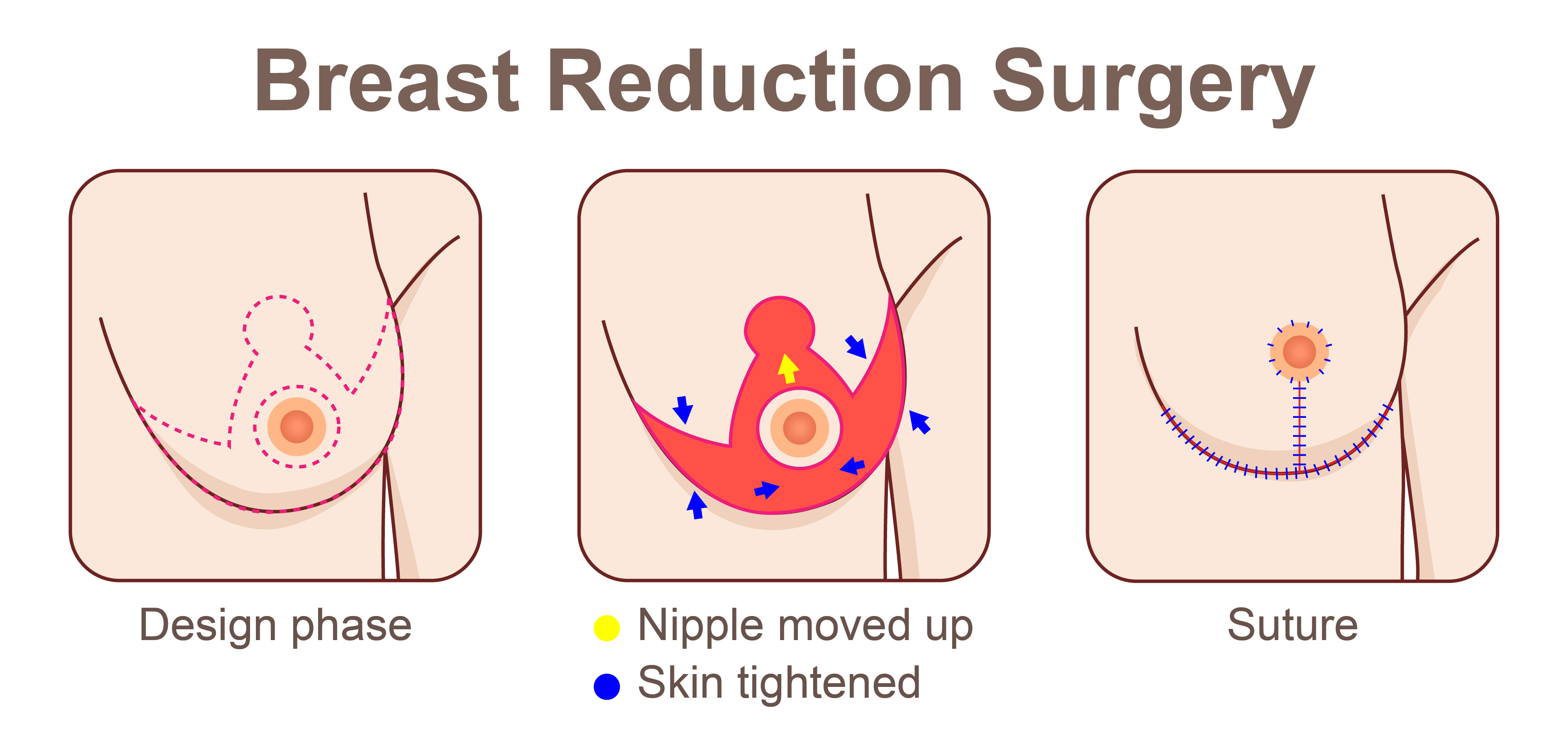 Breast Implants Surgery in Pune