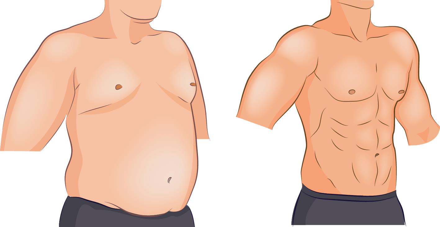 Gynaecomastia Surgery in Pune