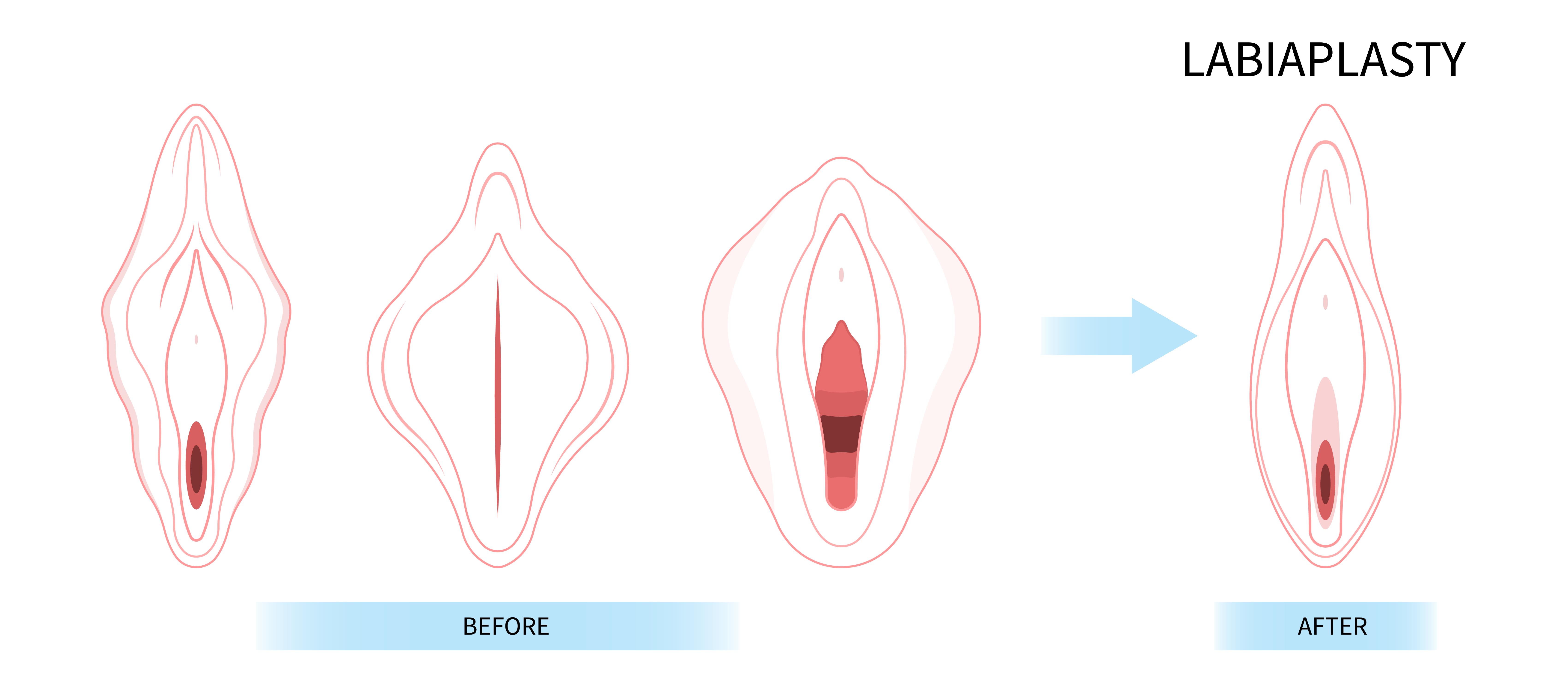 Best Genital Cosmetic Surgery in Pune
