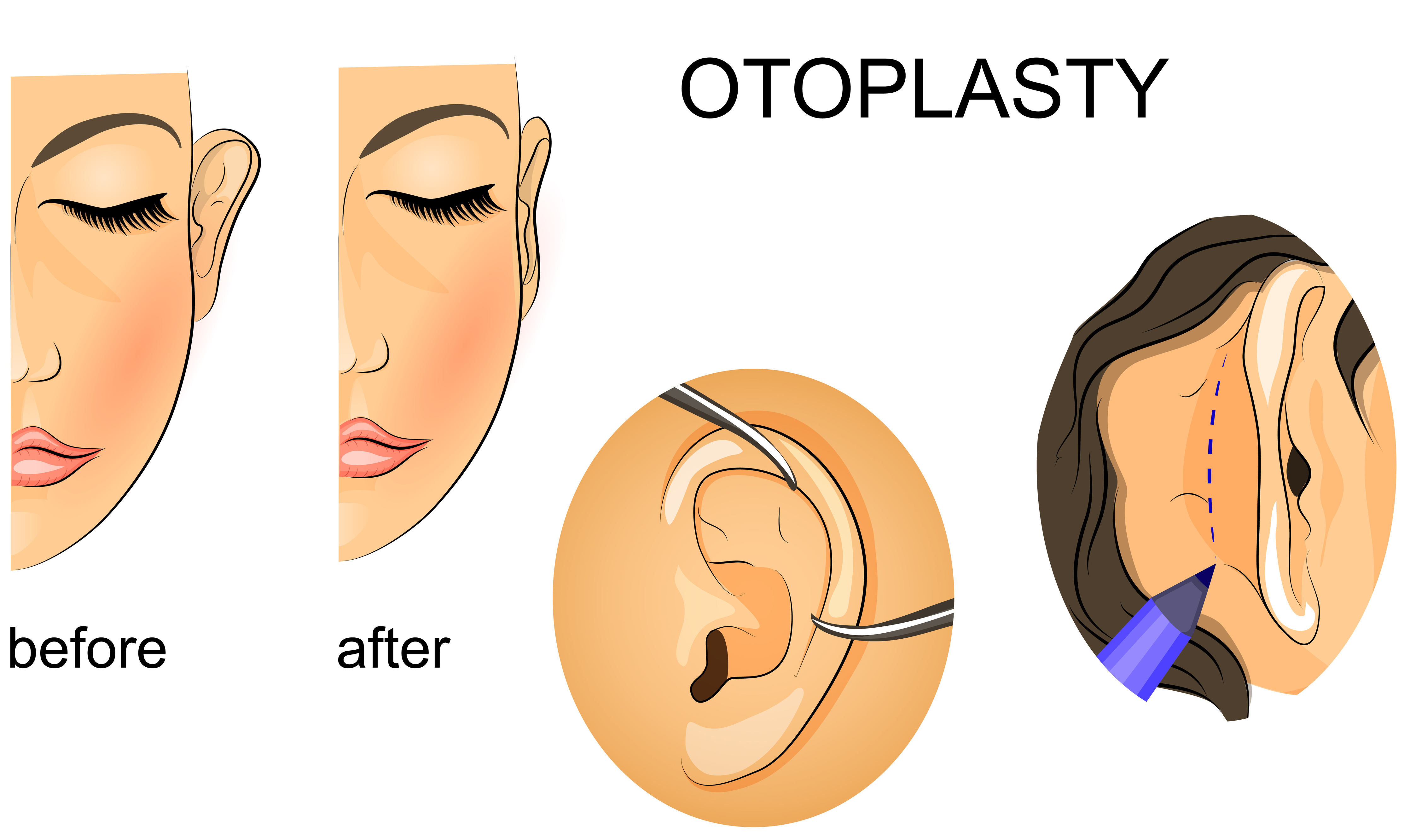 Best Otoplasty surgery in Pune