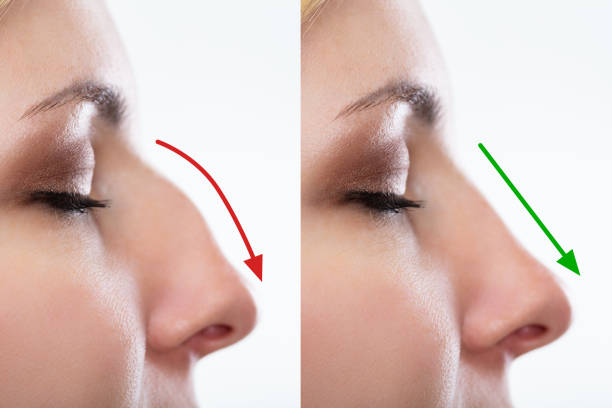 Rhinoplasty Surgery in Pune