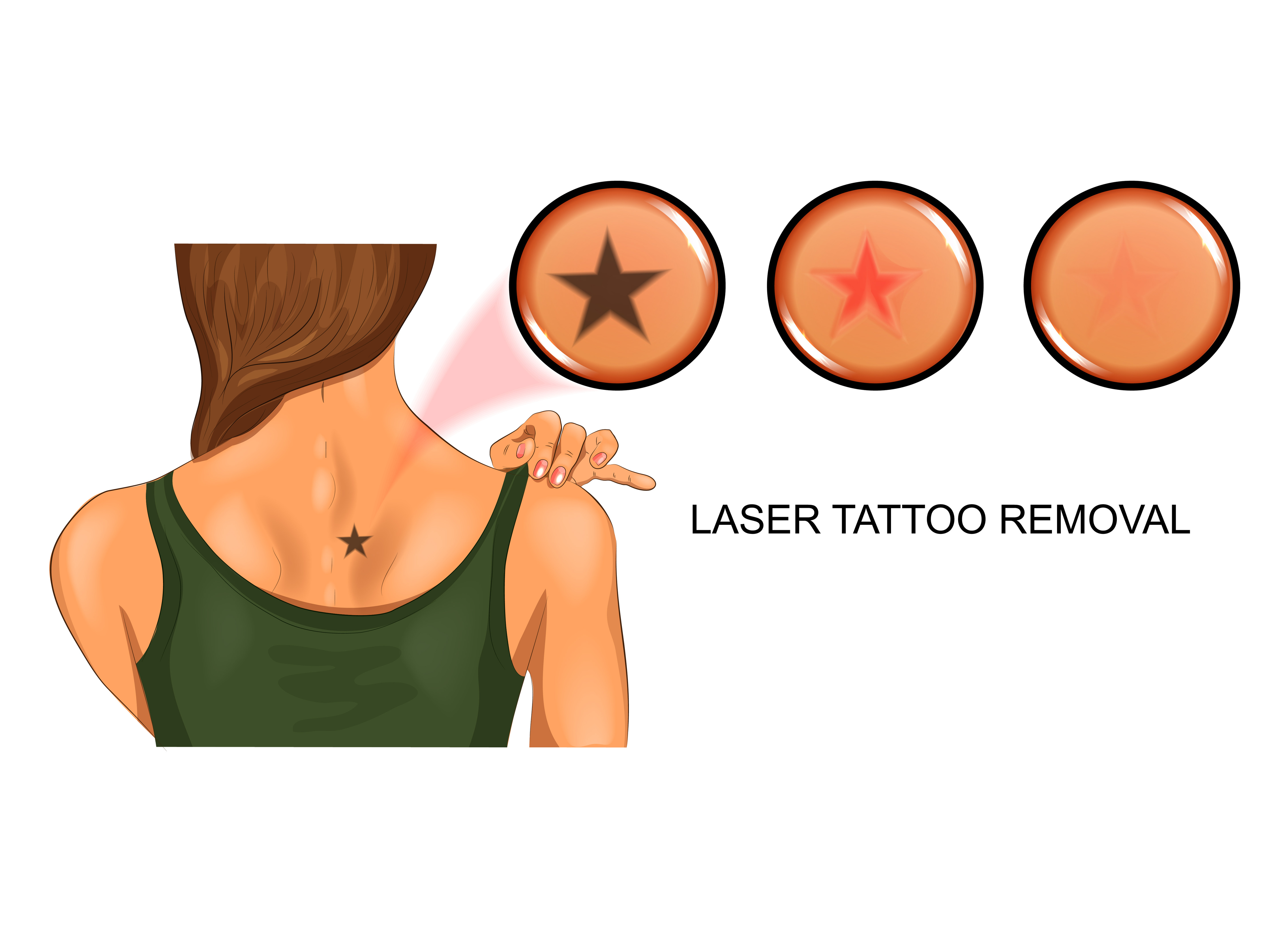 Best Doctor for Tattoo Removal in Pune